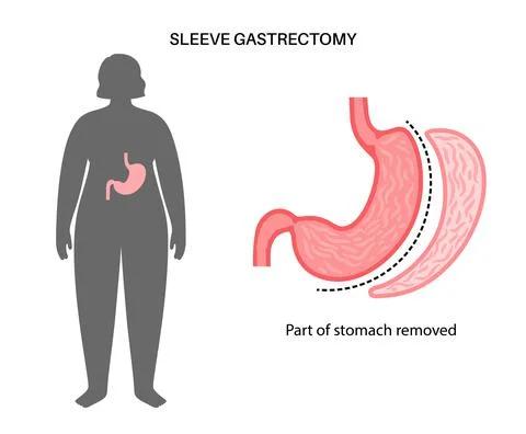 Laparoscopic sleeve gastrectomy Stock Illustration