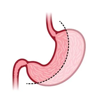 Laparoscopic sleeve gastrectomy Stock Illustration