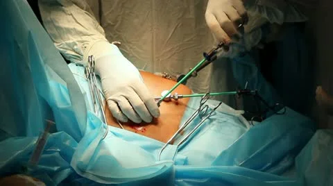 Laparoscopic surgery 1 Stock Footage 21944548