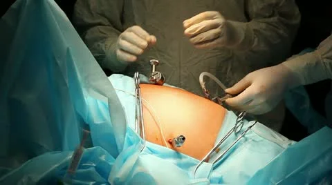 Laparoscopic surgery 2 Stock-Footage 21944542