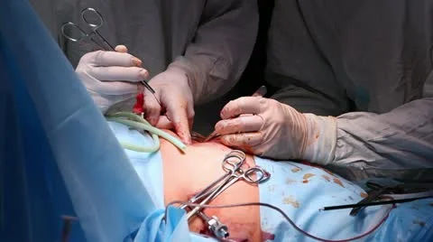 Laparoscopic surgery 4 Stock-Footage 21943807