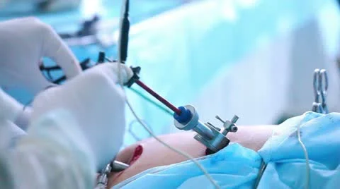 Laparoscopic surgery of the abdomen 1 스톡 동영상 21944635
