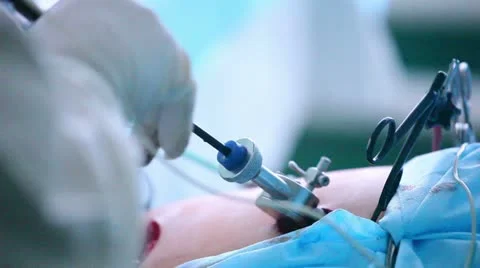Laparoscopic surgery of the abdomen 2 스톡 동영상 21944609