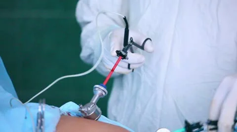 Laparoscopic surgery of the abdomen 4 Stock-Footage 21944599
