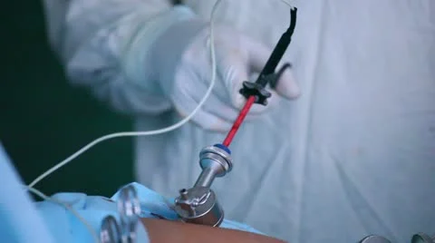 Laparoscopic surgery of the abdomen 5 스톡 동영상 21944592