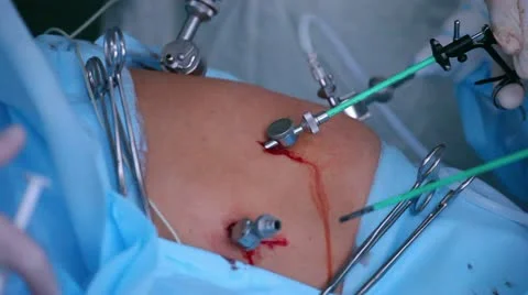 Laparoscopic surgery of the abdomen 7 Stock Footage 21944568