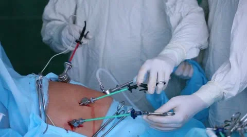 Laparoscopic surgery of the abdomen 8 Stock-Footage 21944567