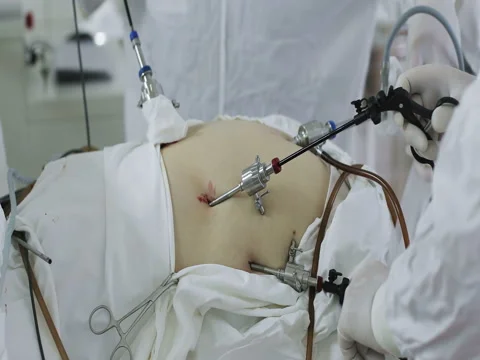 Laparoscopic surgery of the abdomen. Stock Footage 73884148