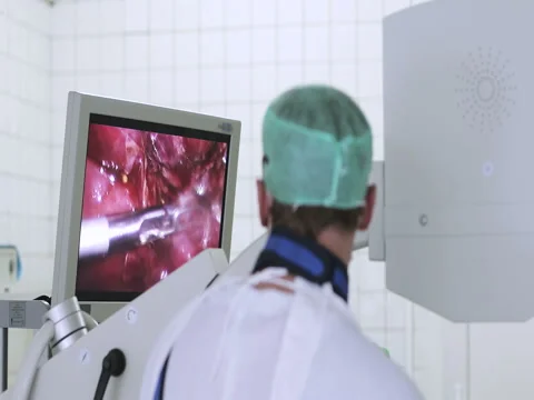 Laparoscopic surgery of the abdomen. Stock Footage 73885640