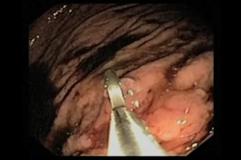 Laparoscopic surgery and Endoscopic medical procedures Vidéo 1073751