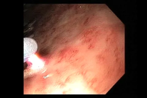 Laparoscopic surgery and Endoscopic medical procedures Stock Footage