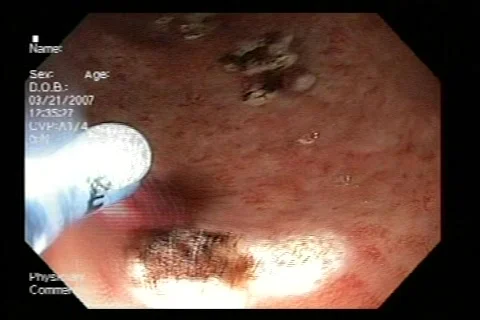 Laparoscopic surgery and Endoscopic Procedures Stock Footage 651672