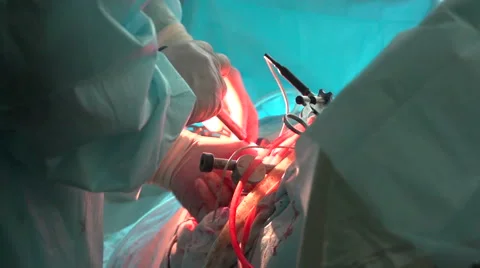 Laparoscopic surgery, close up Stock-Footage 42478178