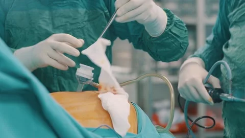 Laparoscopic Surgery Stock Footage 144559779