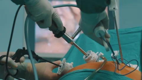 Laparoscopic Surgery Stock Footage 144559822