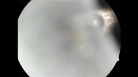 Laparoscopic surgical procedure Stock-Footage 42920430