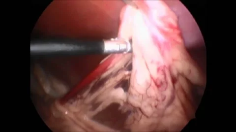 Laparoscopic surgical procedure Stock-Footage 42920707