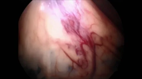 Laparoscopic surgical procedure Stock-Footage 42920709