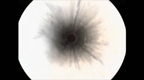 Laparoscopic surgical procedure 스톡 동영상 42920743