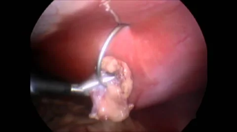Laparoscopic surgical procedure Stock-Footage 42921015