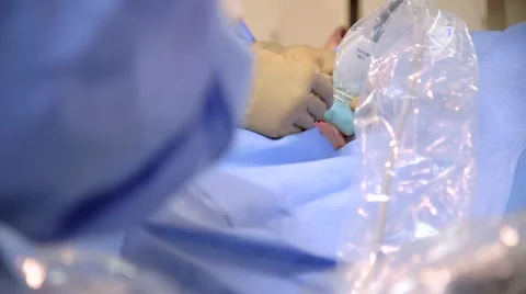Laparoscopy Tube Inserted into Patient Stock-Footage 62805895