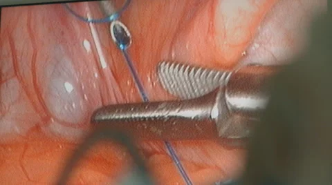 Laporoscopic surgery, macro Stock Footage 64422149