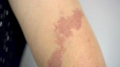 Large birthmark on the arm close-up. The capillaries are close to the skin Stockbeeldmateriaal 214523665