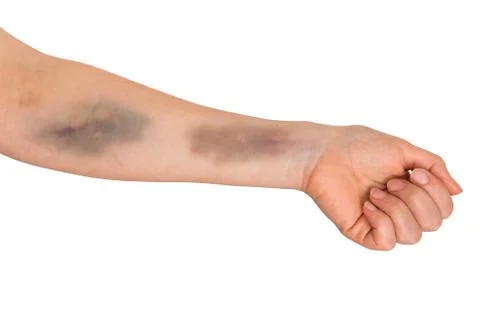 Large bruise on human arm. Injection bruises. Stock Photos