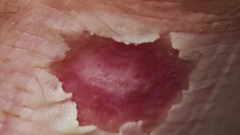 Large deep callus on Achilles after a long walk Stock Footage 207727310