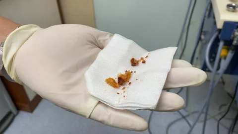 Large ear wax dirty dark brown impacted cerumen on gauze removed by ENT doctor Stock Footage 342276883