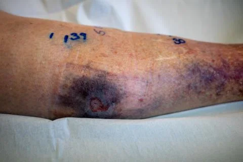Large haematoma is located on a lower leg, its spread is marked with a pen Stock Photos