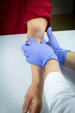 Large hematoma on human arm Stock Photos