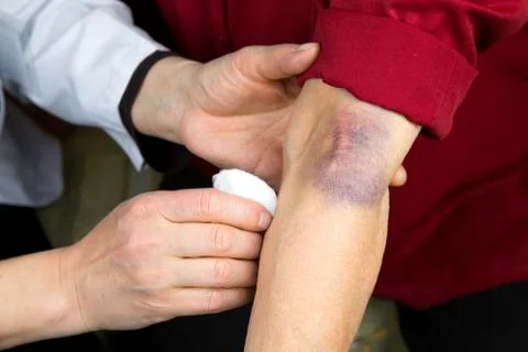 Large hematoma on human arm Stock Photos