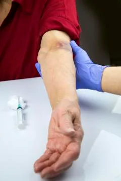 Large hematoma on human arm Stock Photos