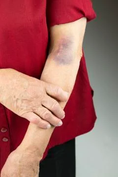 Large hematoma on human arm Stock Photos