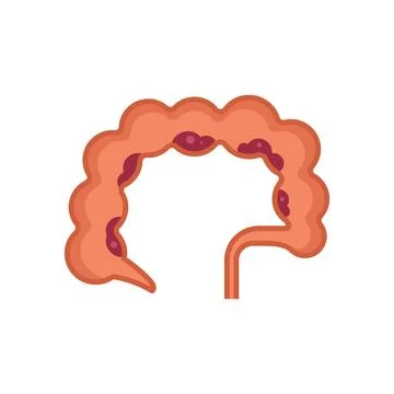 Large intestine showing diverticulitis with appendix illustration Stock Illustration