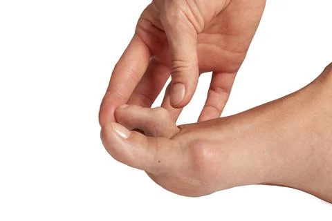 A large leg with a sore toe affected by hallux valgus. Stock Photos