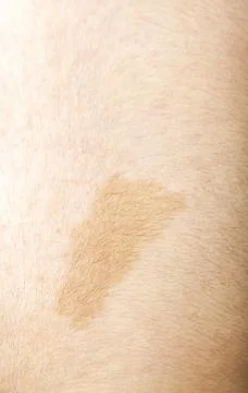 A large light brown cafe au lait spot known as birth mark on the inter scapul Stock Photos