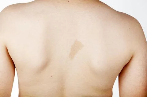 A large light brown cafe au lait spot known as birth mark on the inter scapul Stock Photos