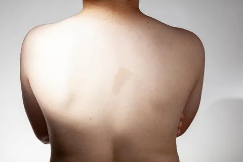 A large light brown cafe au lait spot known as birth mark on the inter scapul Stock Photos