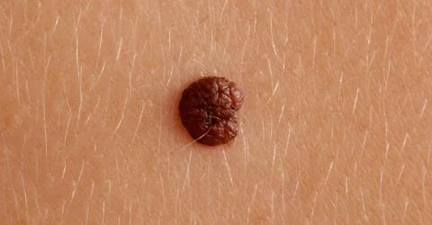 Large mole on the skin Stock Photos