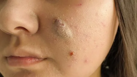A large pimple, a blister with fluid on the cheek of a young woman. Acne on the Stock Footage 325366171