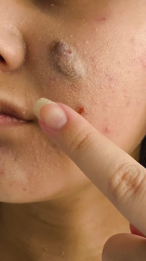 A large pimple, a blister with fluid on the cheek of a young woman. Acne on the Stock Footage 325366236