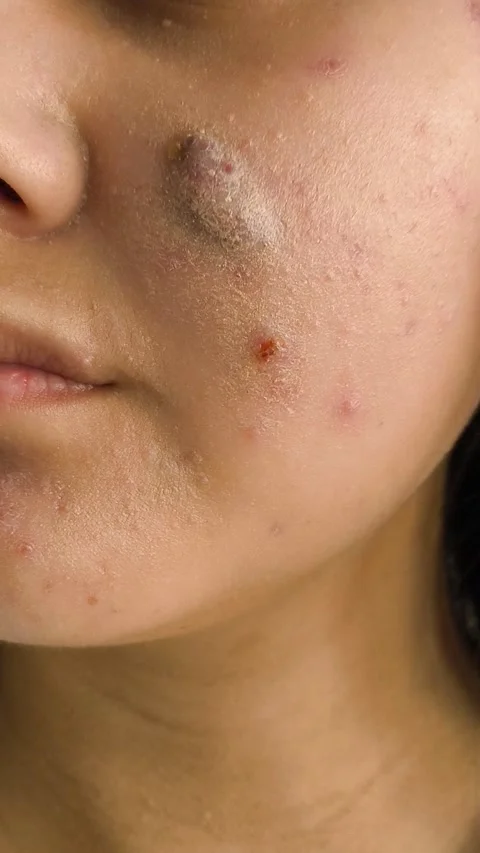 A large pimple, a blister with fluid on the cheek of a young woman. Acne on the Stock Footage 325366246