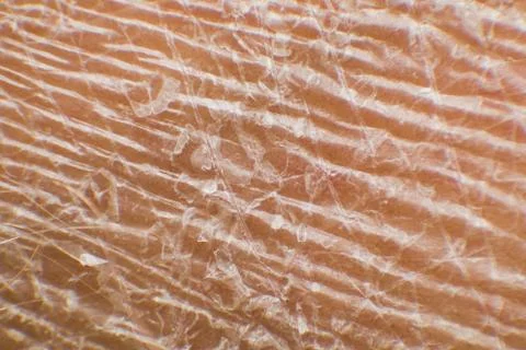 Large plaque parapsoriasis super macro on caucasian man legs Stock Photos