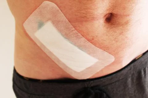 A large plaster on the man's abdomen. Consequences of appendicitis Photos