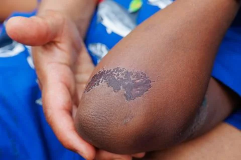 Large scab on the arm of a young boy of african ethnicity Stock Photos