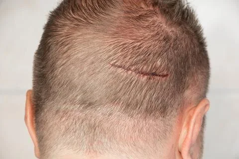 Large scratch on the head of a man from falling head on a corner in the pool, Stock Photos