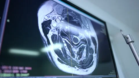 Large screen with the MRI scan of human brain. Stock Footage 293159484