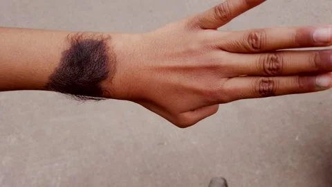 A Large sized black Mole with hairy skin on a Human hand in India. Stock Footage 293264411
